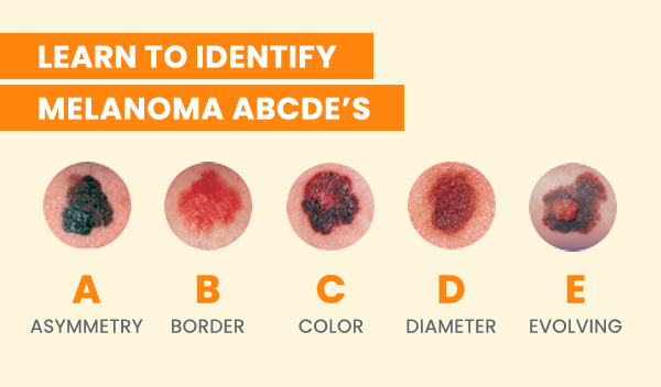 Learn To Identify Melanoma ABCDE'S