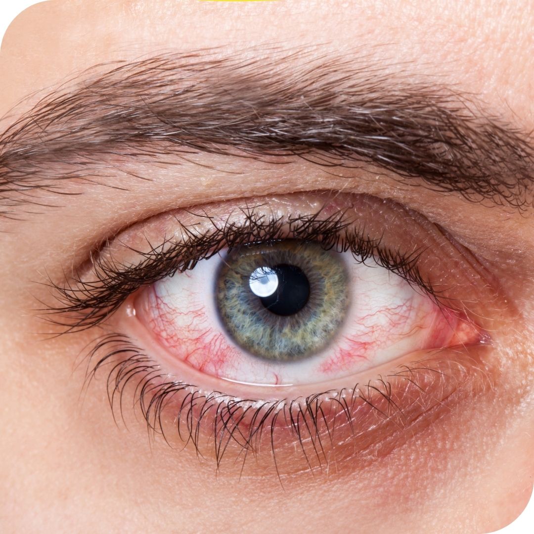 Ditch the itch of seasonal allergies.