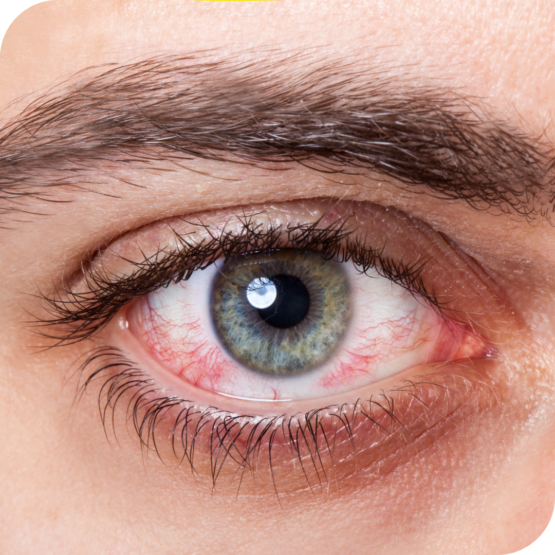 What causes red eyes?