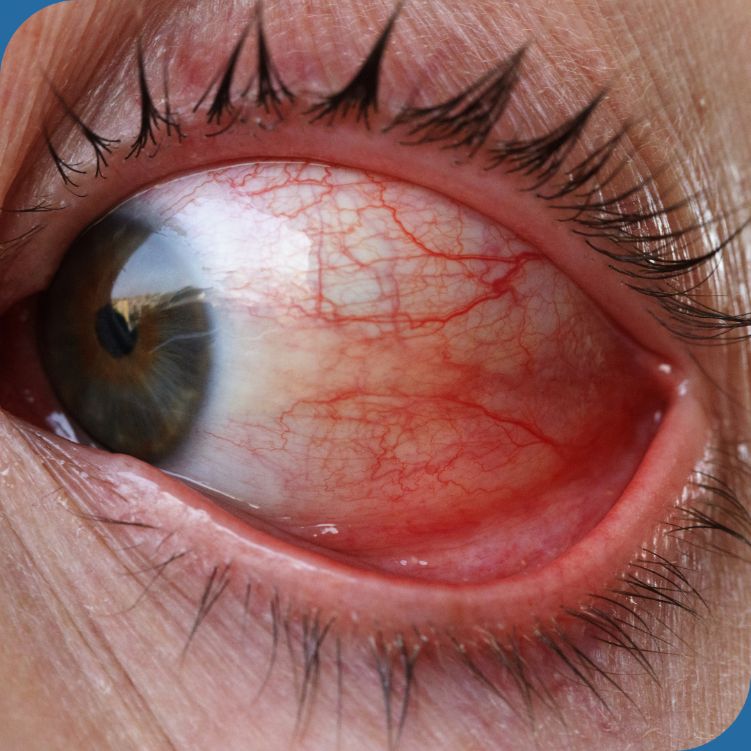 What's causing your red eyes?