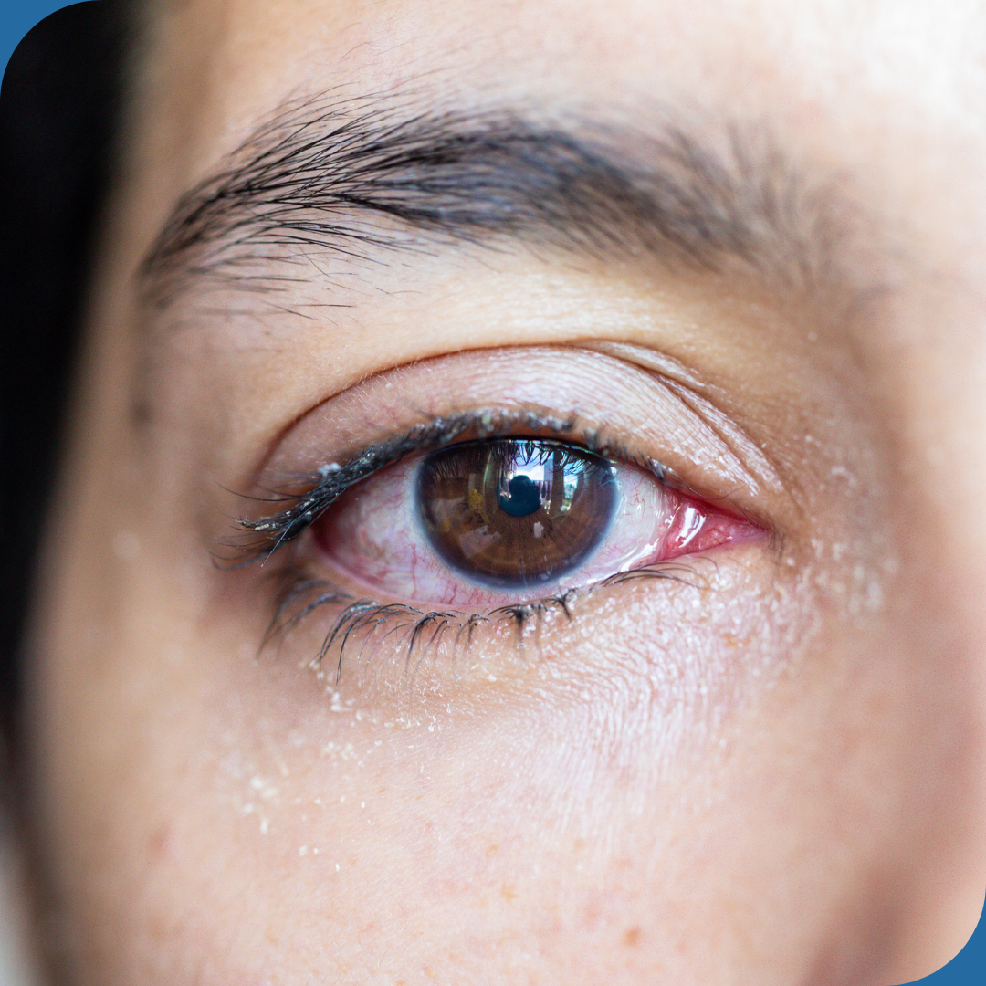 Blepharitis
