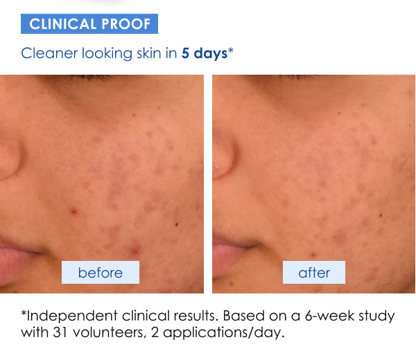 Dermalogica Acne Biotic Moisturizer Test Result