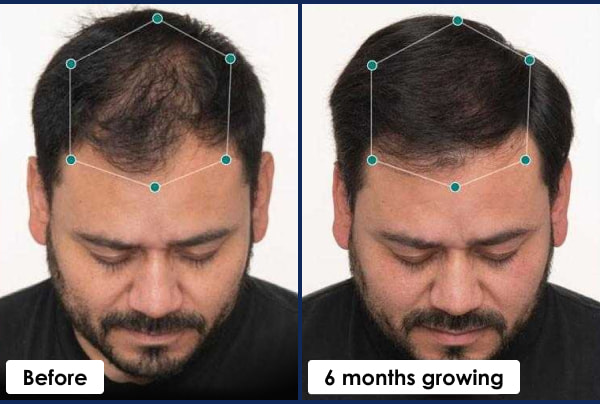 Nutrafol Men Hair Growth Nutraceutical. Test Results.
