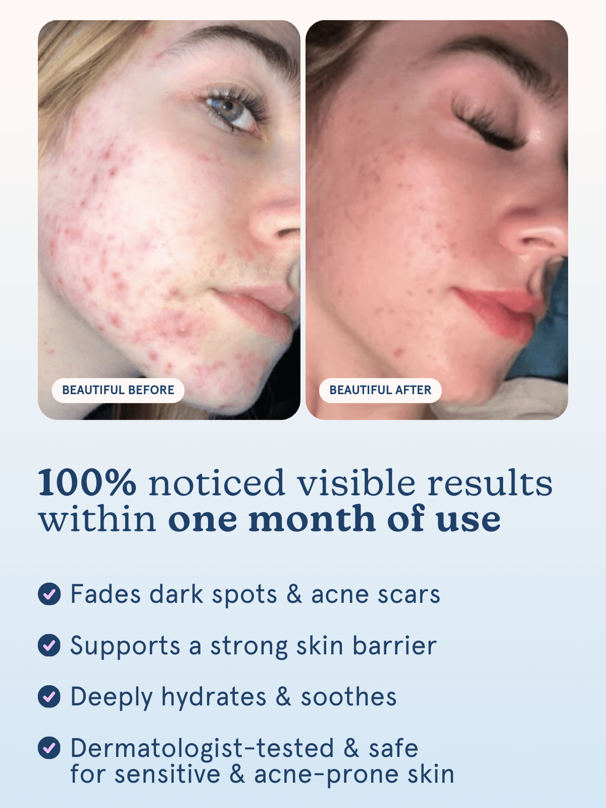 100% noticed visible results within one month of use | Fades dark spots & acne scars, Supports a strong skin barrier, Deeply hydrates & soothes, Dermatologist-tested & safe for sensitive & acne-prone skin⁠