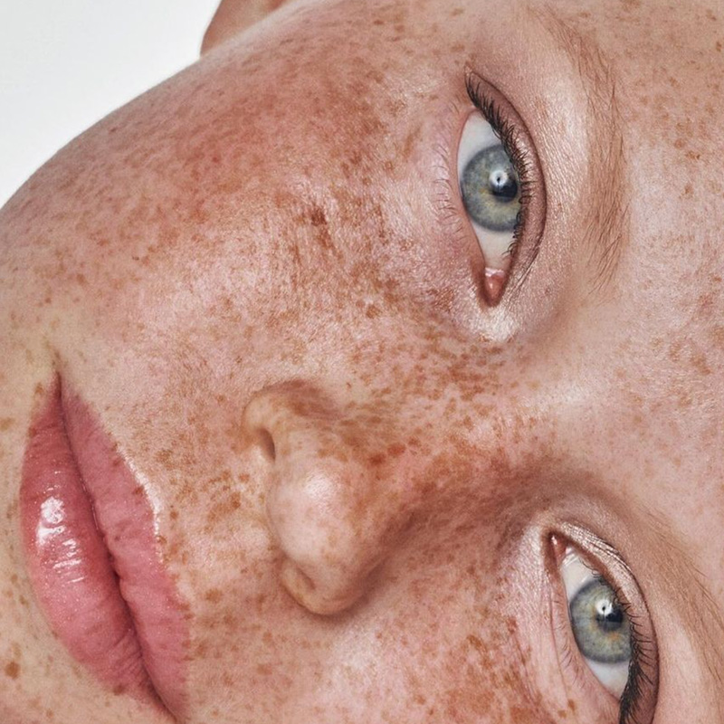 Oily skin