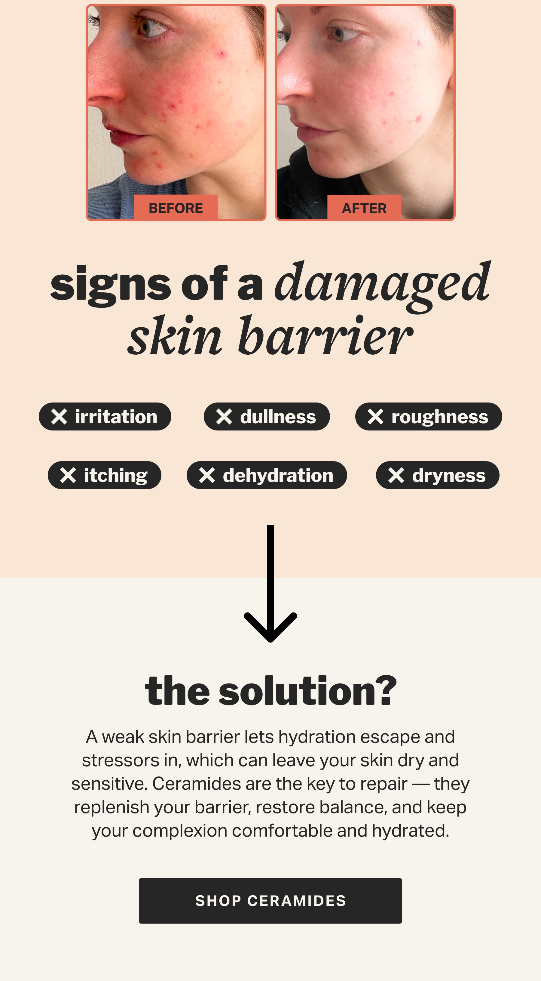 signs of a damaged skin barrier | SHOP CERAMIDES