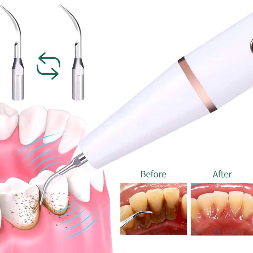 Image of Advanced Electric Teeth Cleaning Tool Powerful Calculus Remover & Tartar Eraser