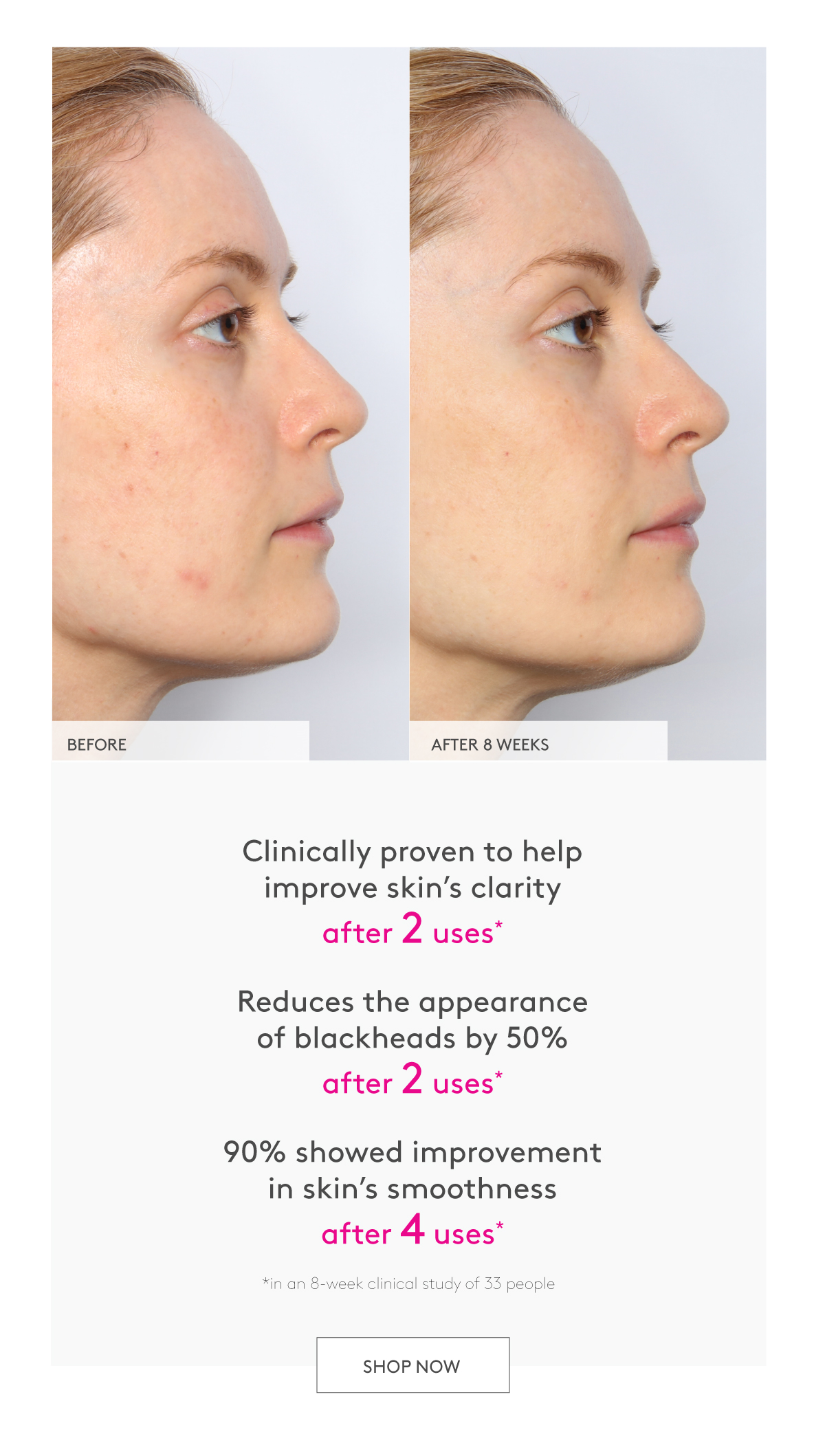 Babyfacial Results