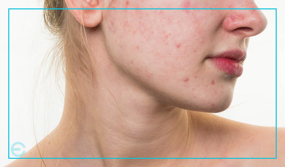 ACNE REDNESS BLOG