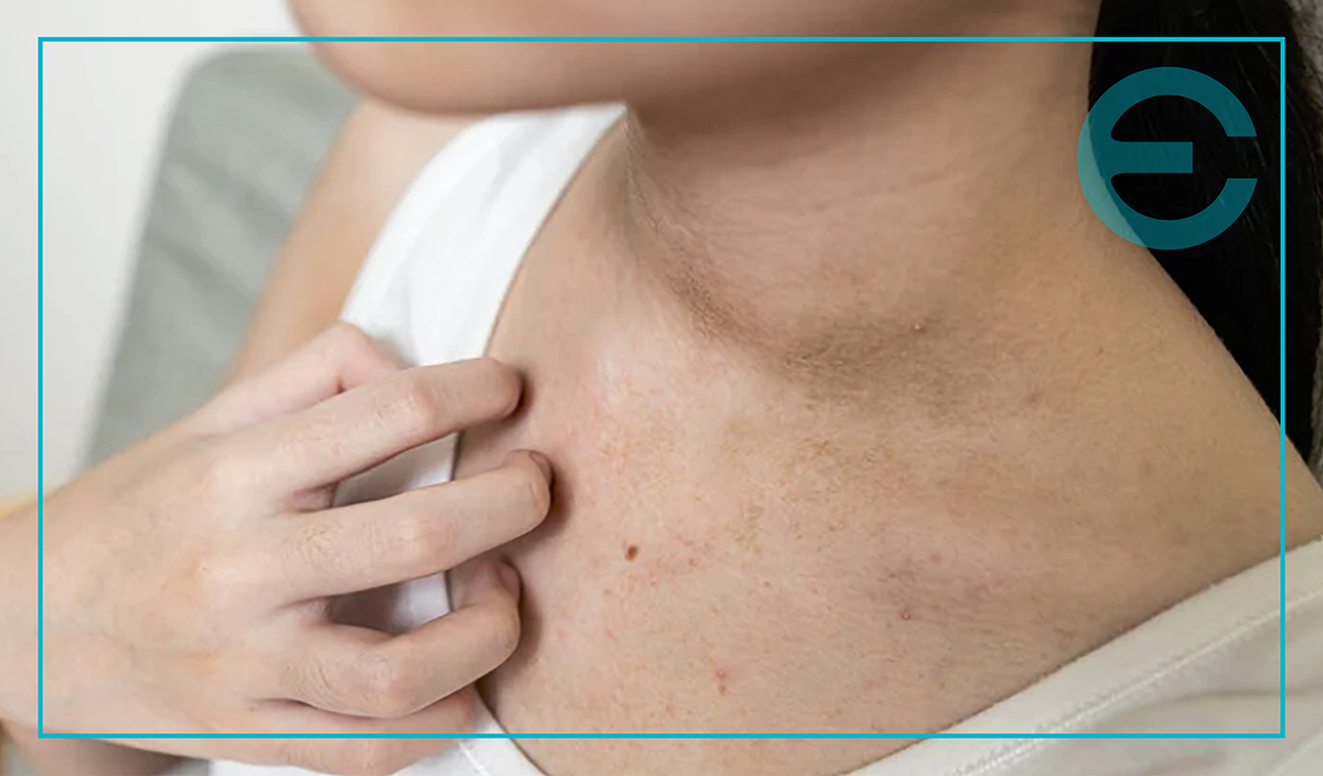 CHEST ACNE BLOG