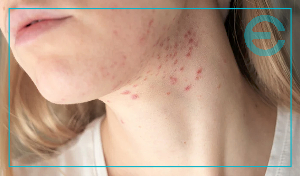 ACNE PRONE SKIN BLOG