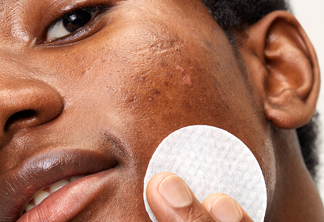 ACNE CLEARING PADS