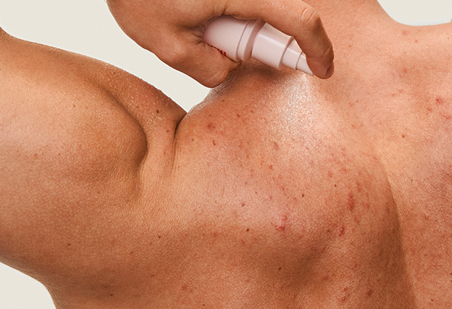 BODY ACNE CLEARING MIST