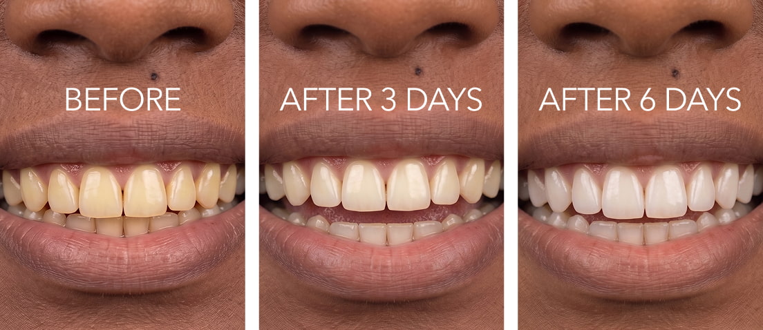 issa™ Teeth Whitening Set