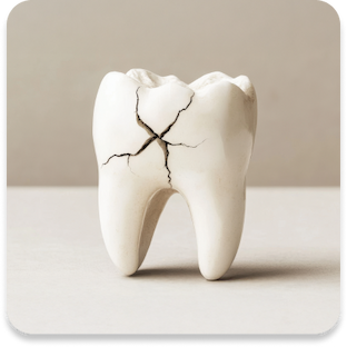 Cracked tooth