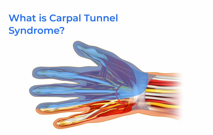 What is Carpal Tunnel Syndrome?