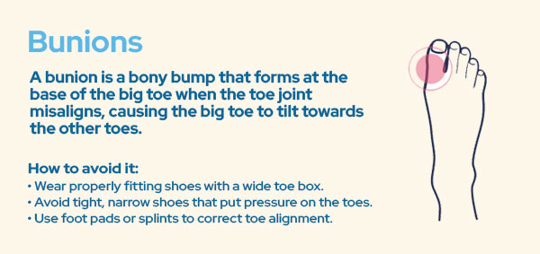 Bunions