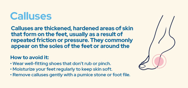  "Calluses"