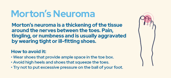 Morton's Neuroma