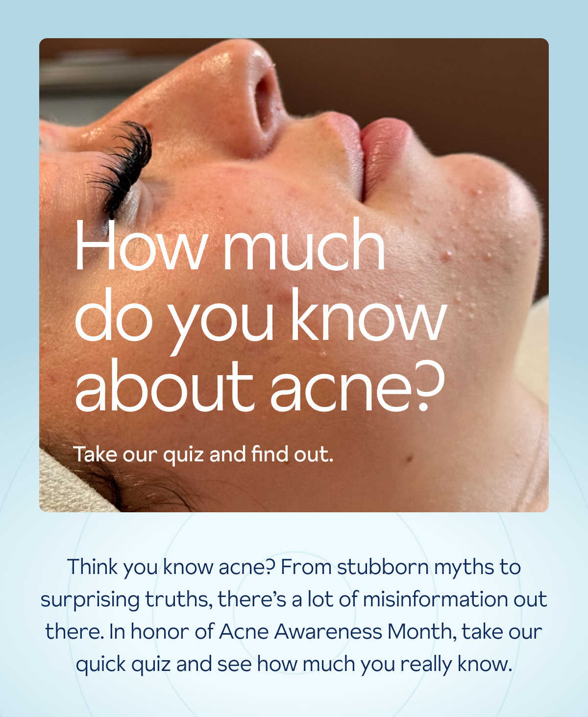 Take our acne quiz