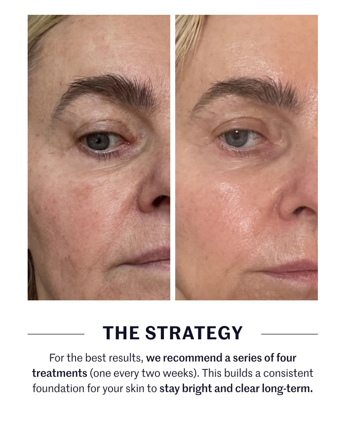 THE STRATEGY  For the best results, we recommend a series of four treatments (one every two weeks). This builds a consistent foundation for your skin to stay bright and clear long-term.