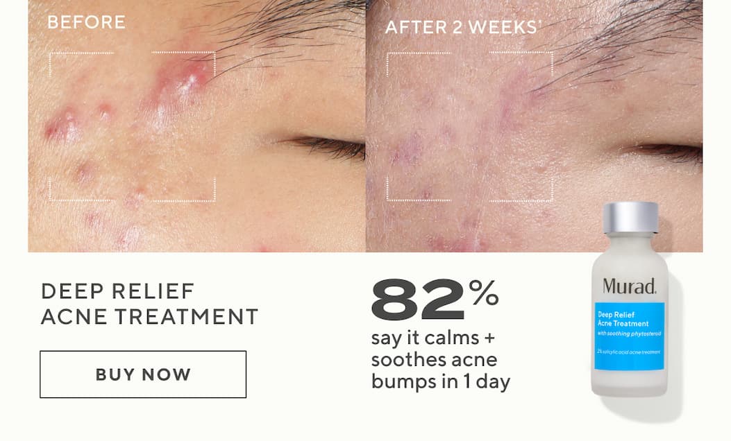 Deep Relief Acne Treatment