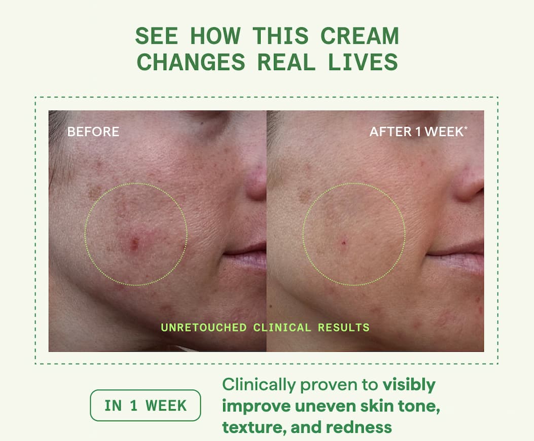 See how this cream changes real lives. Clinically prove to visibly improve uneven skin tone, texture, and redness. Shop now.