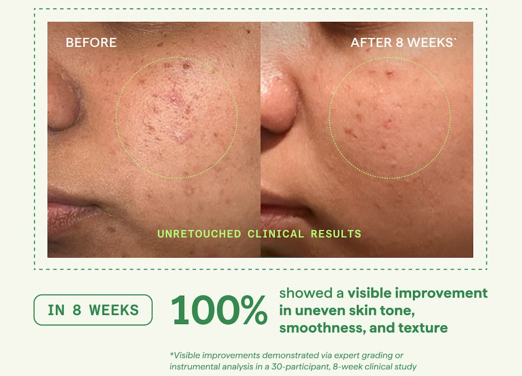 In 8 weeks, 100% showed a visible improvement in uneven skin tone, smoothness, and texture. Shop now