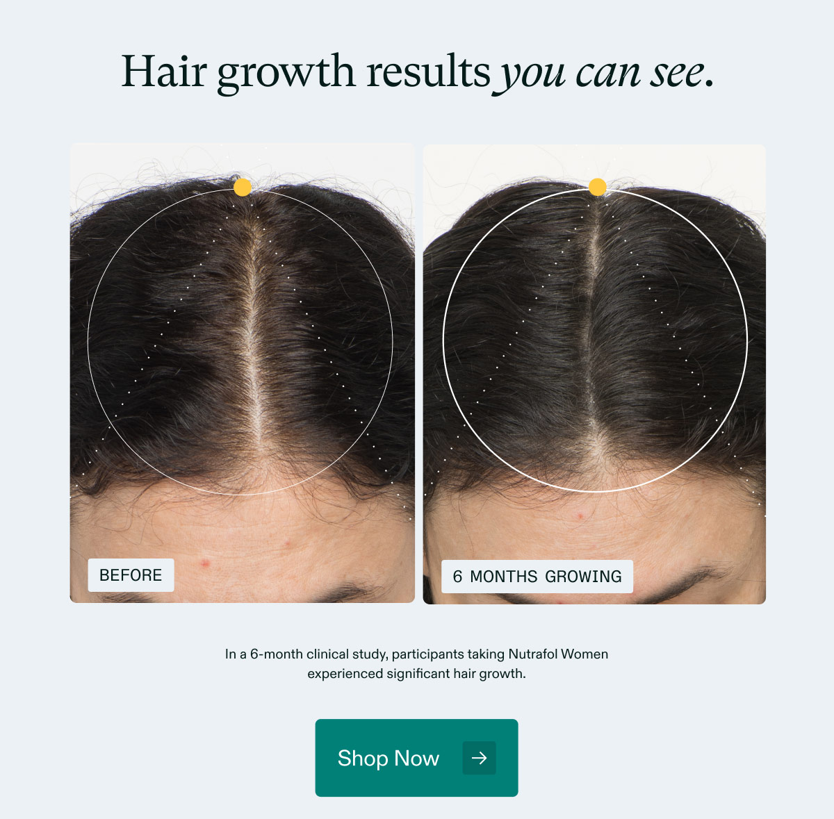Hair growth results you can see. In a 6-month clinical study, participants taking Nutrafol Womenexperienced significant hair growth. Shop Now.