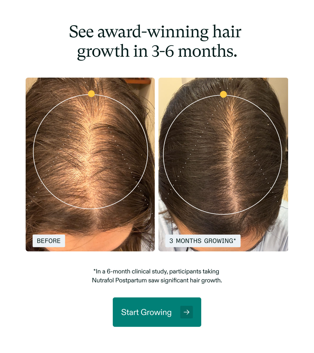 See award-winning hair growth in 3-6 months. *In a 6-month clinical study, participants taking Nutrafol Postpartum saw significant hair growth. Start Growing.