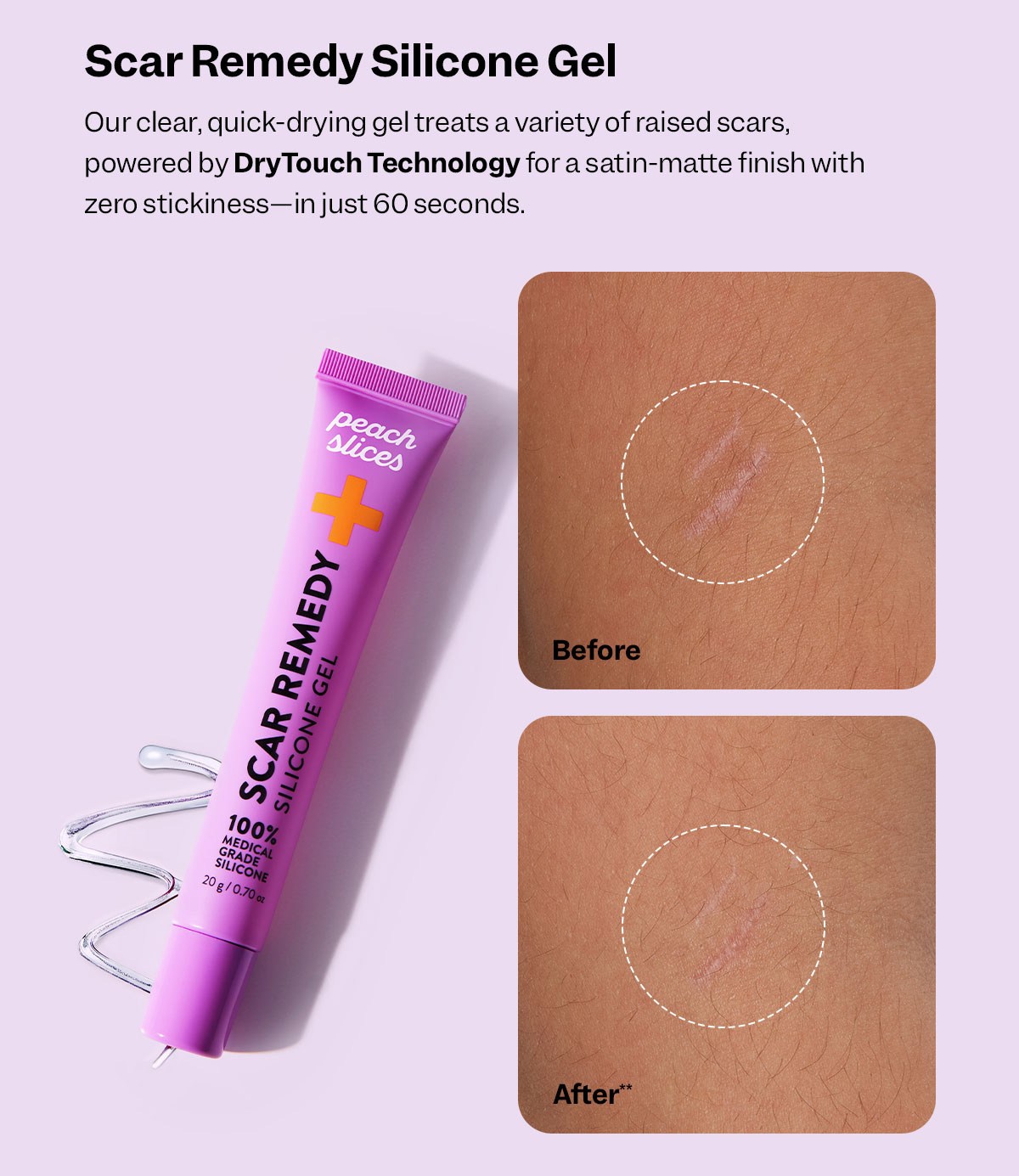 Scar Remedy Silicone Gel: Our clinically-proven gel visibly flattens and fades old and new scars.