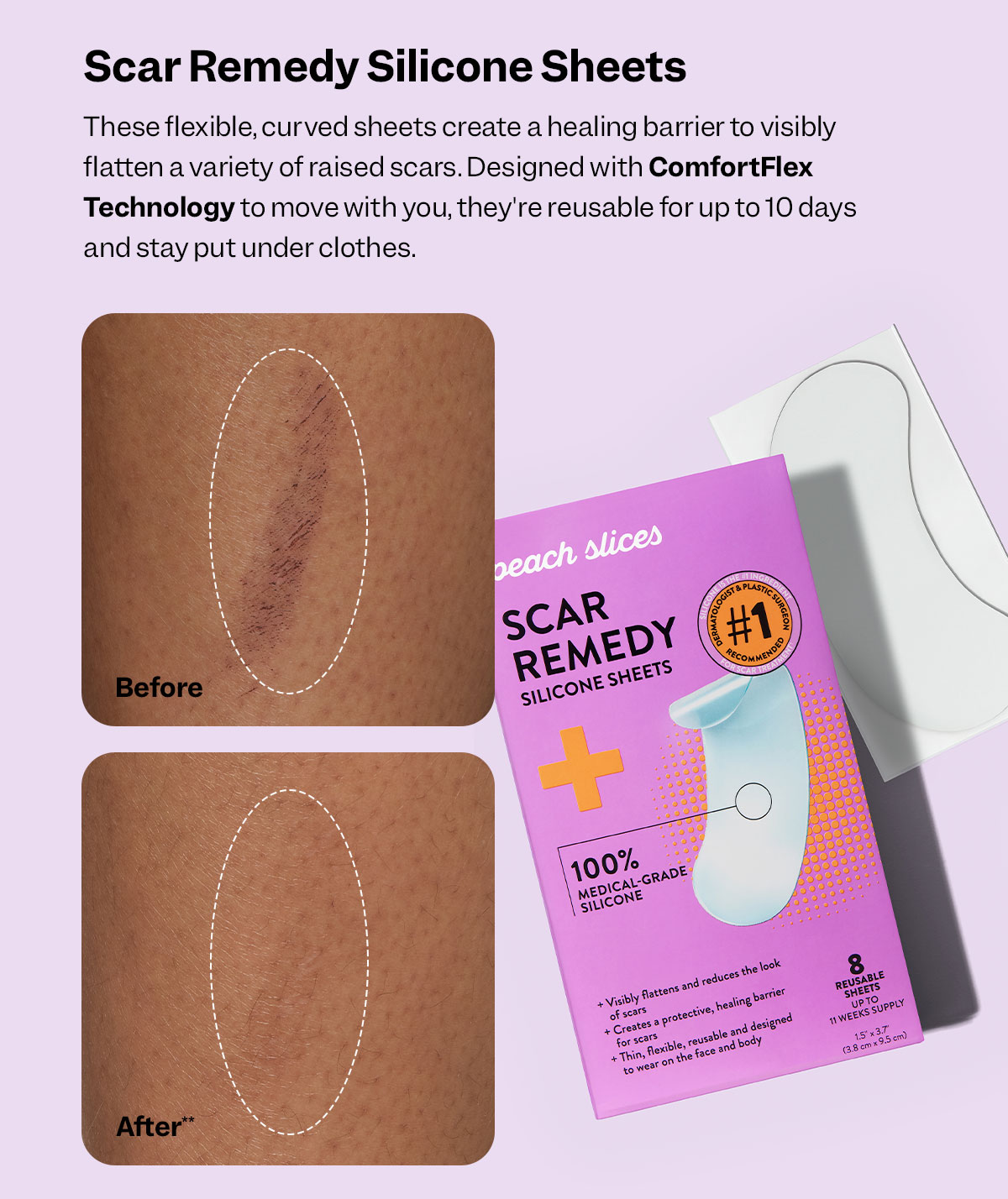 Scar Remedy Silicone Sheets: Our clinically-proven, curved, flexible sheets visibly flatten and fade old and new scars.