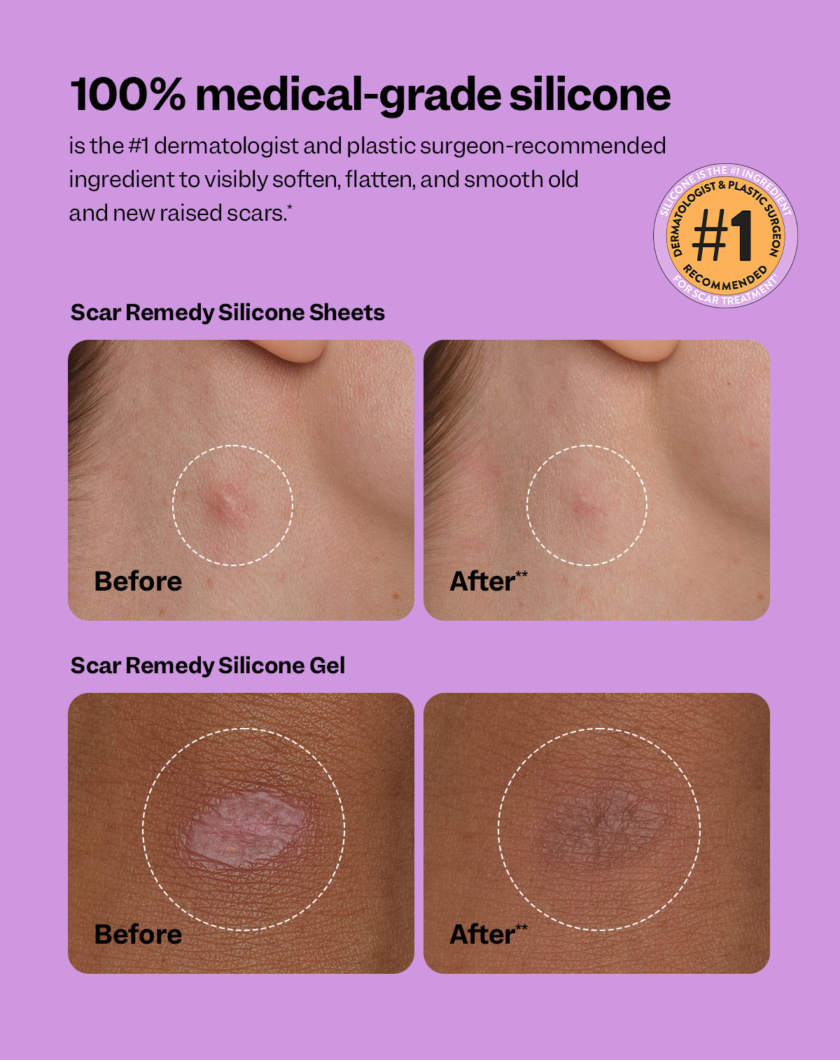 100% medical-grade silicone is the #1 dermatologist and plastic surgeon-recommended ingredient to visibly soften, flatten, and smooth old and new raised scars.*
