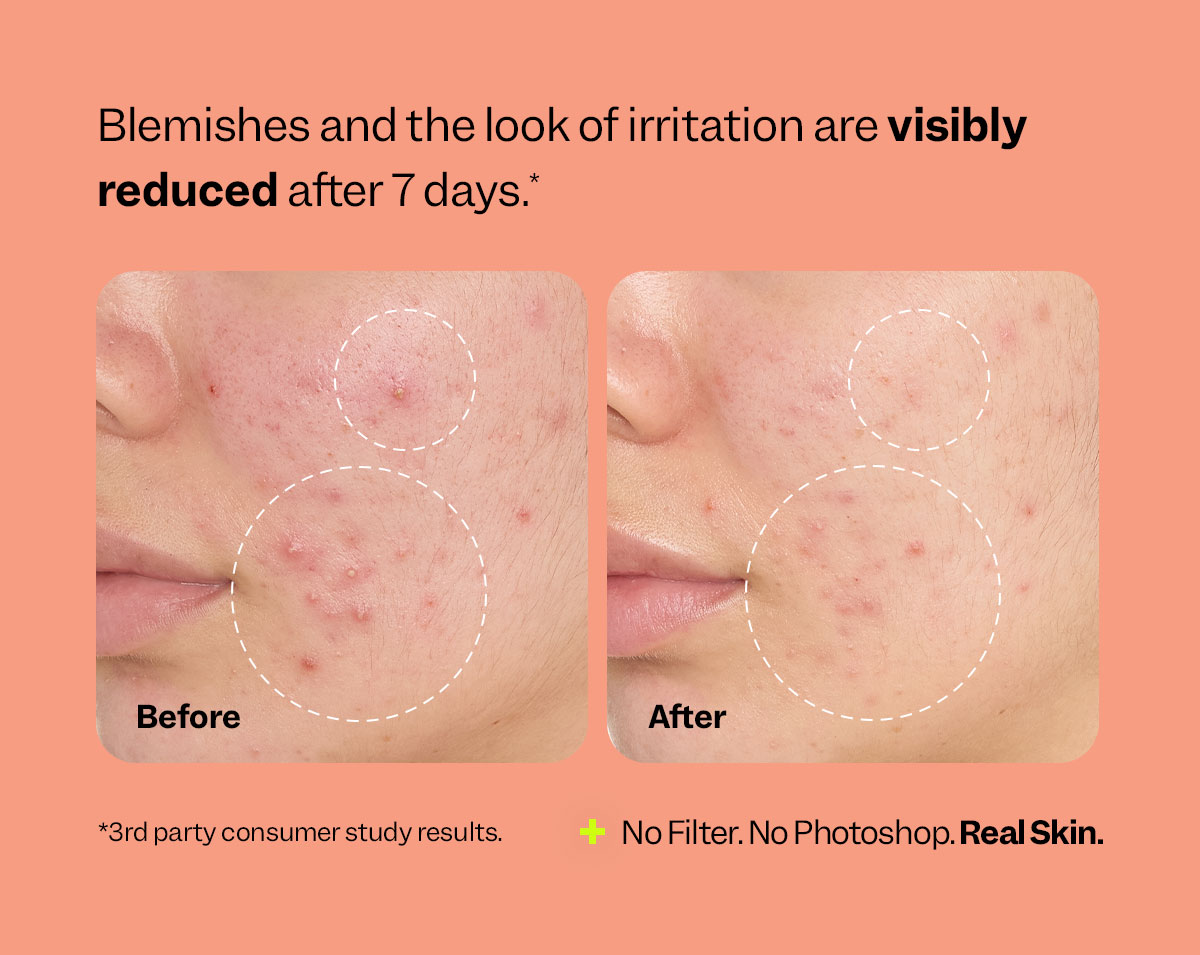 Spray away redness, blemishes, and nearly every skin stressor.