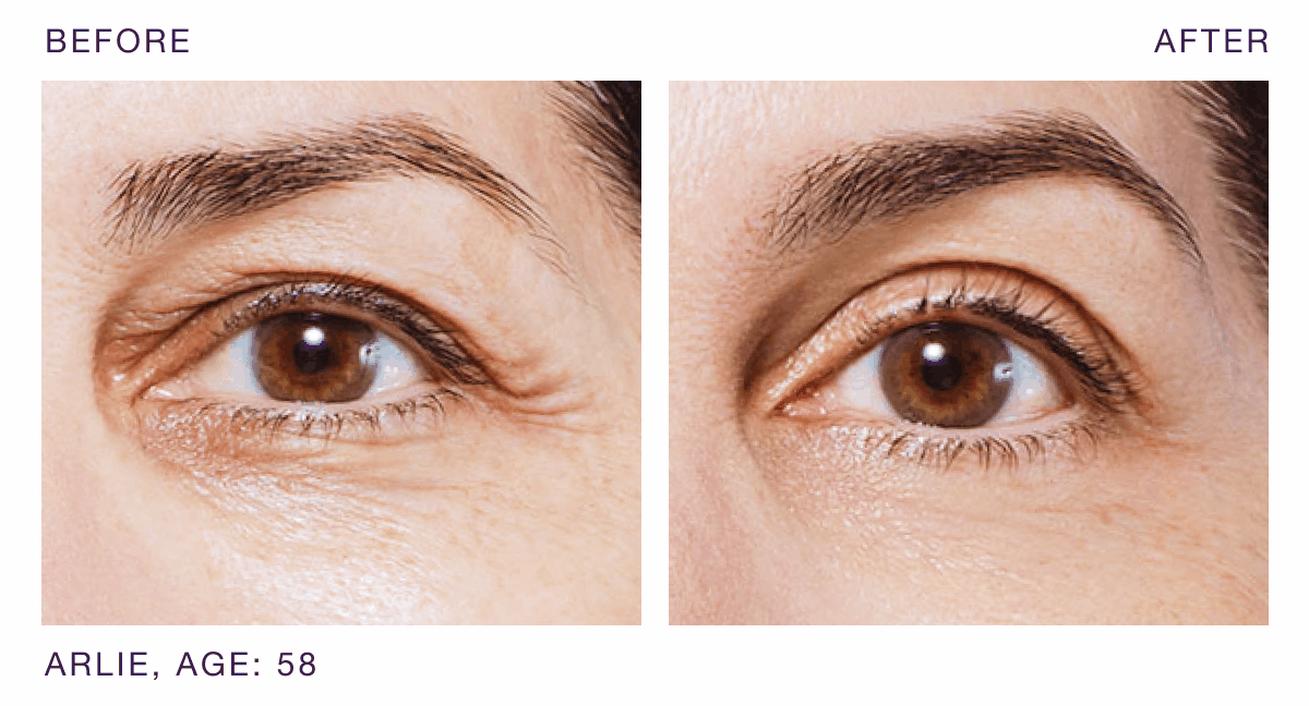 B&A Eye