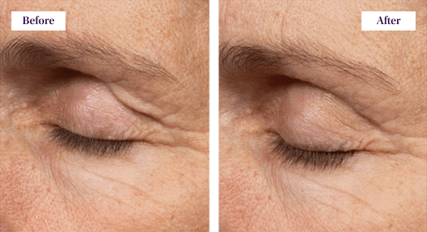 Before & After
