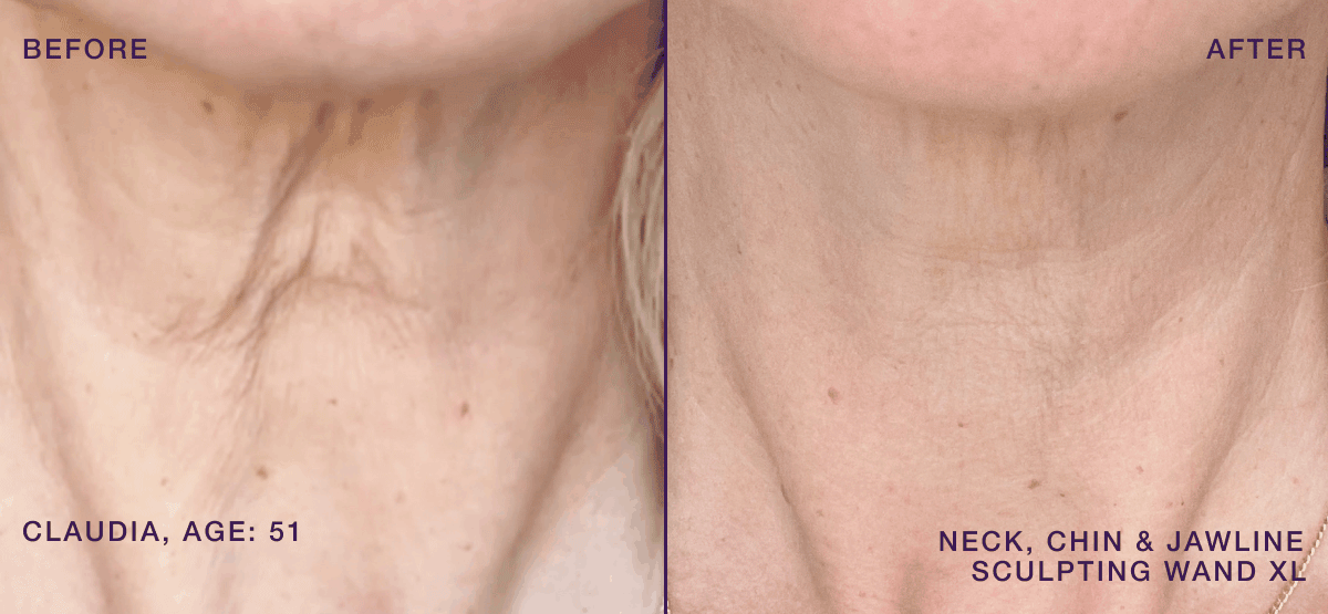 Before & After