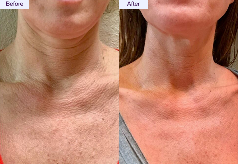 Before After