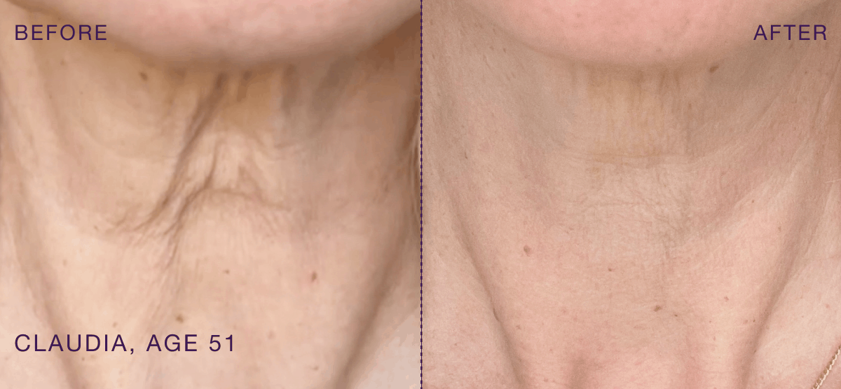 BEFORE & AFTER