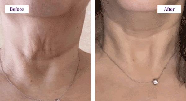 Before & After