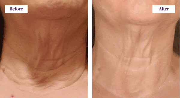 BEFORE & AFTER