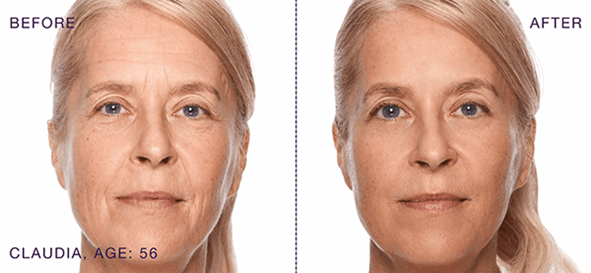 BEFORE & AFTER