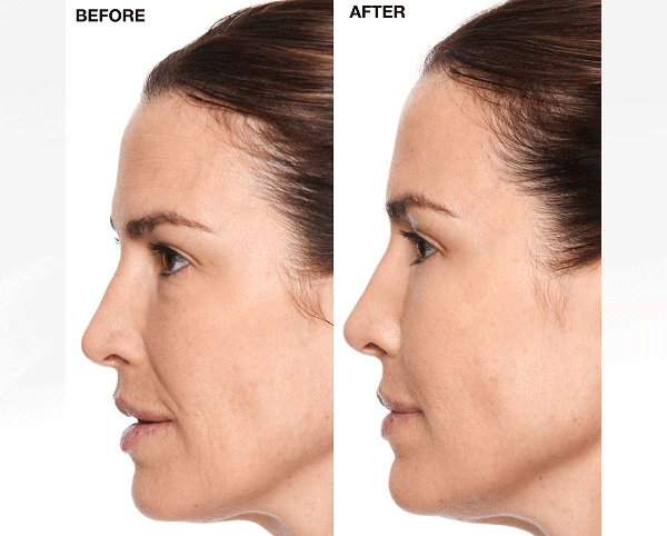 Before/After