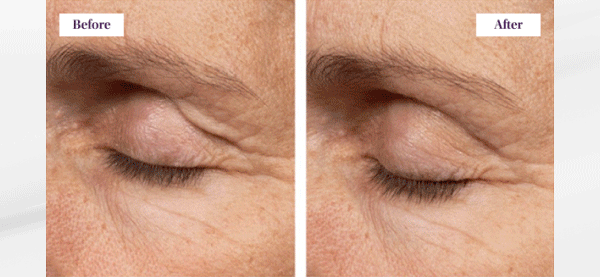 SAVE 30% OFF EYE LIFT WAND