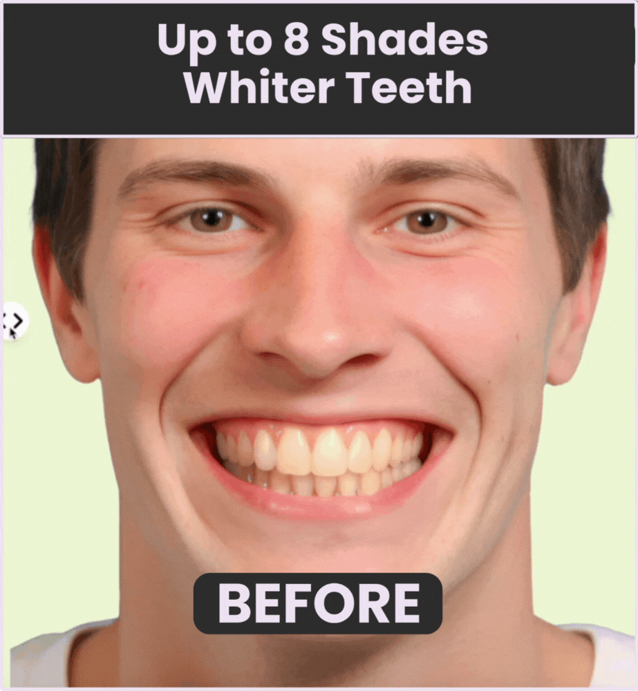 Whiten Teeth