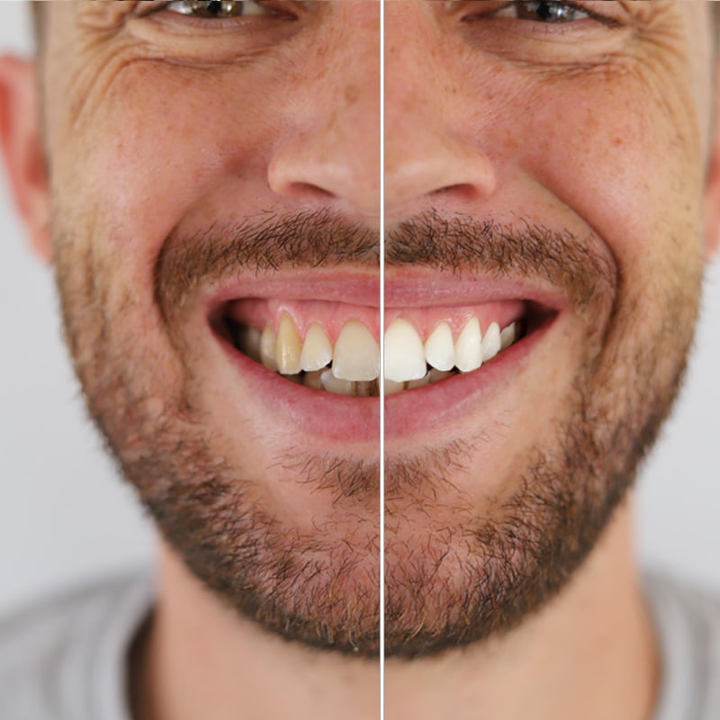 Teeth Whitening – Professional-Grade Results from the Comfort of Home