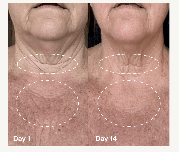 Clinical Results, Mom-Approved