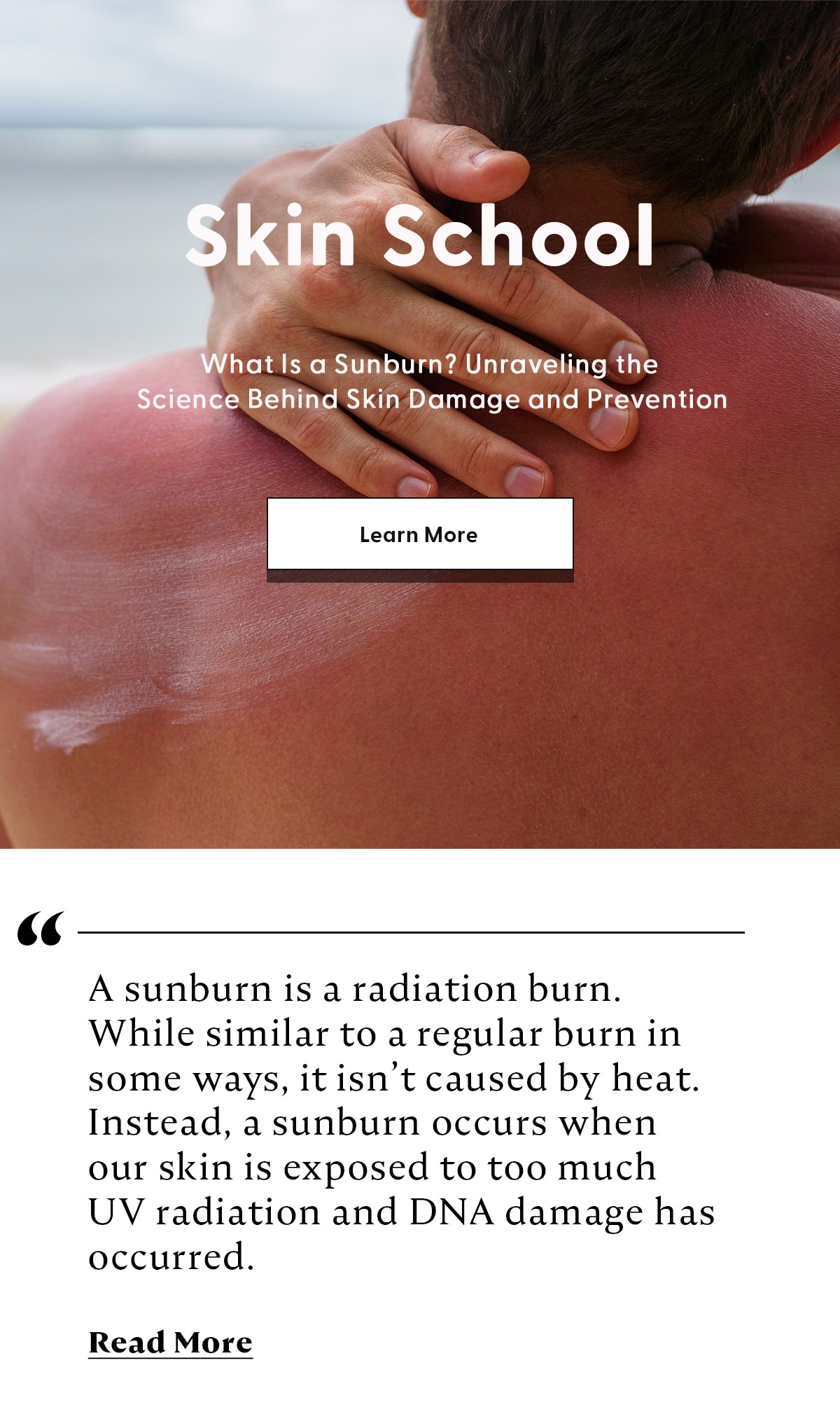 what is a sunburn?